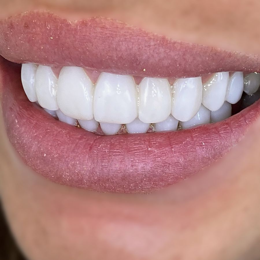 composite bonding after 3dental